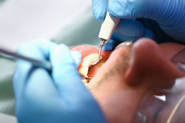 Best Emergency Wisdom Tooth Extraction in Richardson, TX