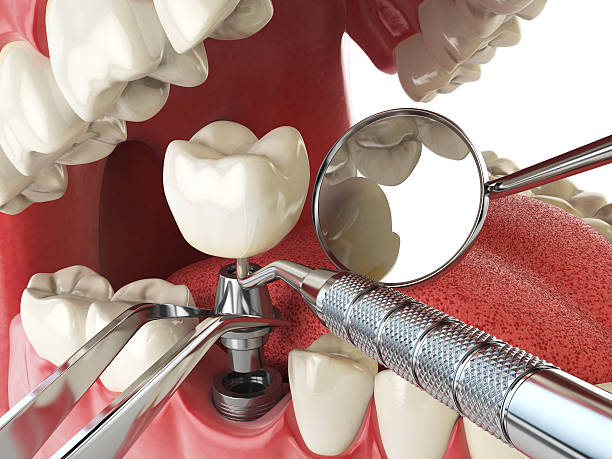 Best Emergency Cosmetic Dentistry (e.g., broken veneers) in Richardson, TX